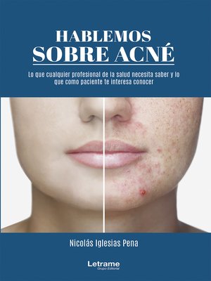 cover image of Hablemos sobre acné